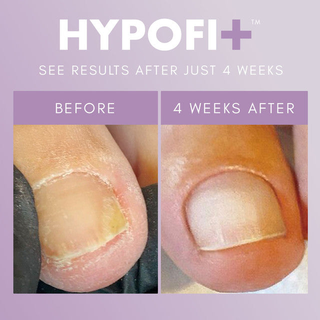 HypoFix™ Bundle - thePINKchair.ca